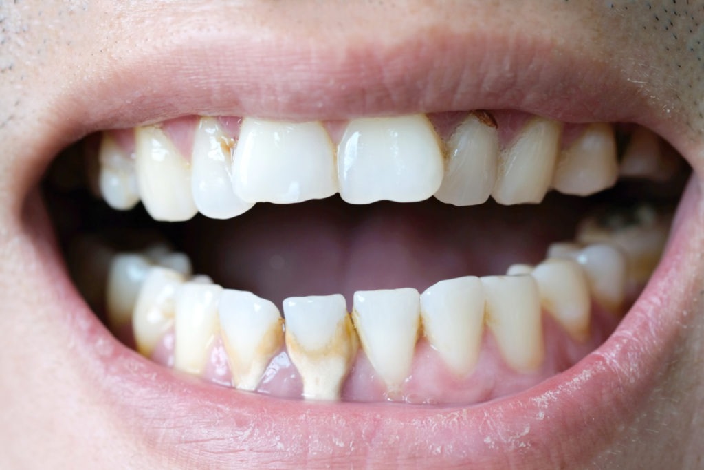 Zapalone i odsłonięte dziąsła powodują nadwrażliwość zębów